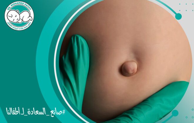 شكل الفتق السري عند الاطفال