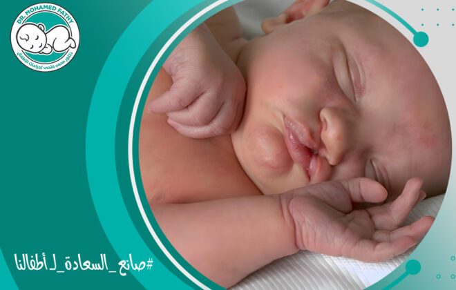 اسباب الشفة الارنبية